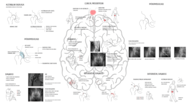 Acetabular dysplasia