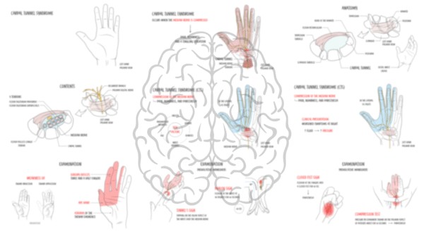 Carpal Tunnel Syndrome
