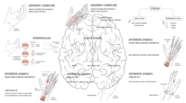 Dupuytren's Contracture