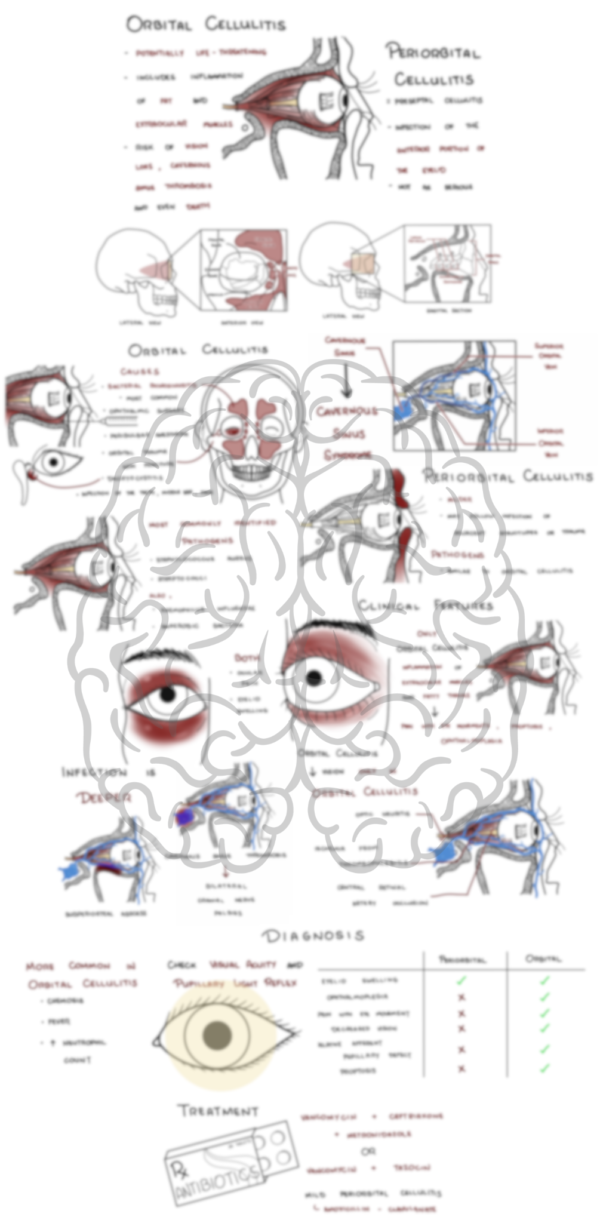 Orbital VS Preorbital Cellulitis