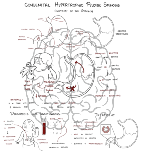 Congenital Hypertrophic Pyloric Stenosis