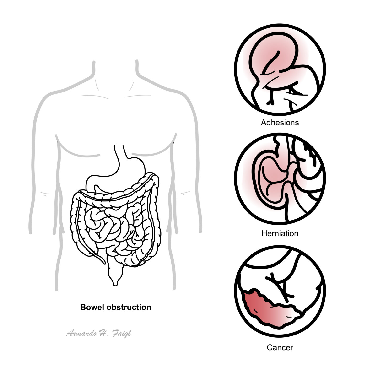 Bowel Obstruction – Armando Hasudungan