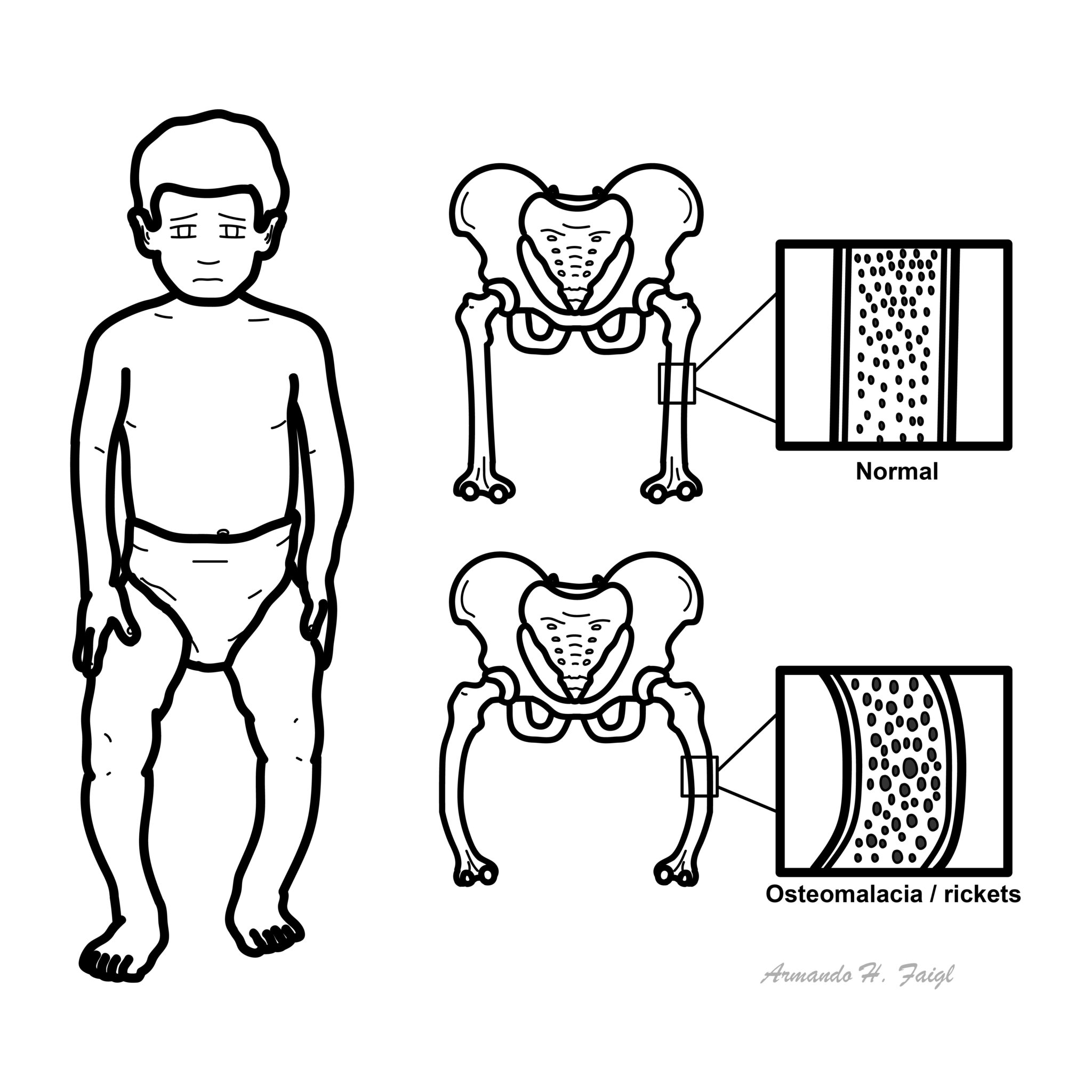 Osteomalacia / Rickets – Armando Hasudungan