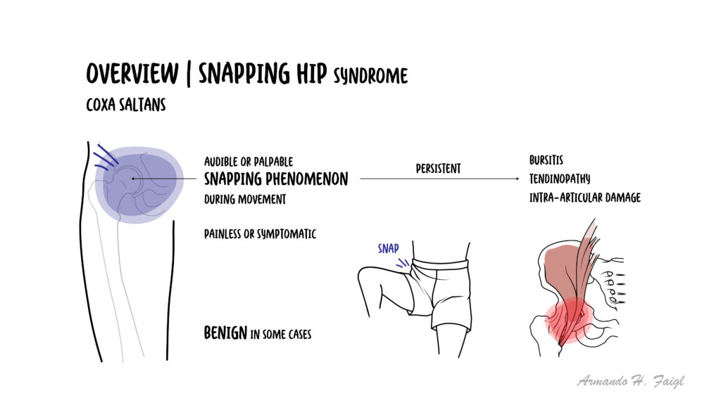 Left Snapping Hip Snapping Hip Syndrome (Coxa Saltans) β Armando Hasudungan