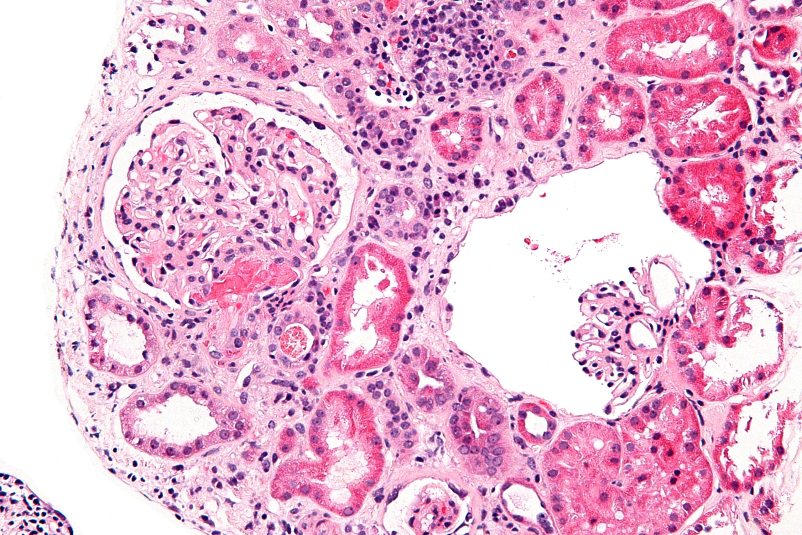 High-magnification kidney biopsy showing glomerular and small-vessel changes of acute thrombotic microangiopathy.