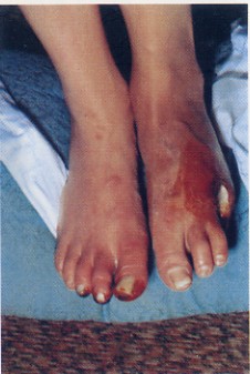 Clinical photograph showing advanced Buerger’s disease with severe distal foot ischaemia and tissue loss.
