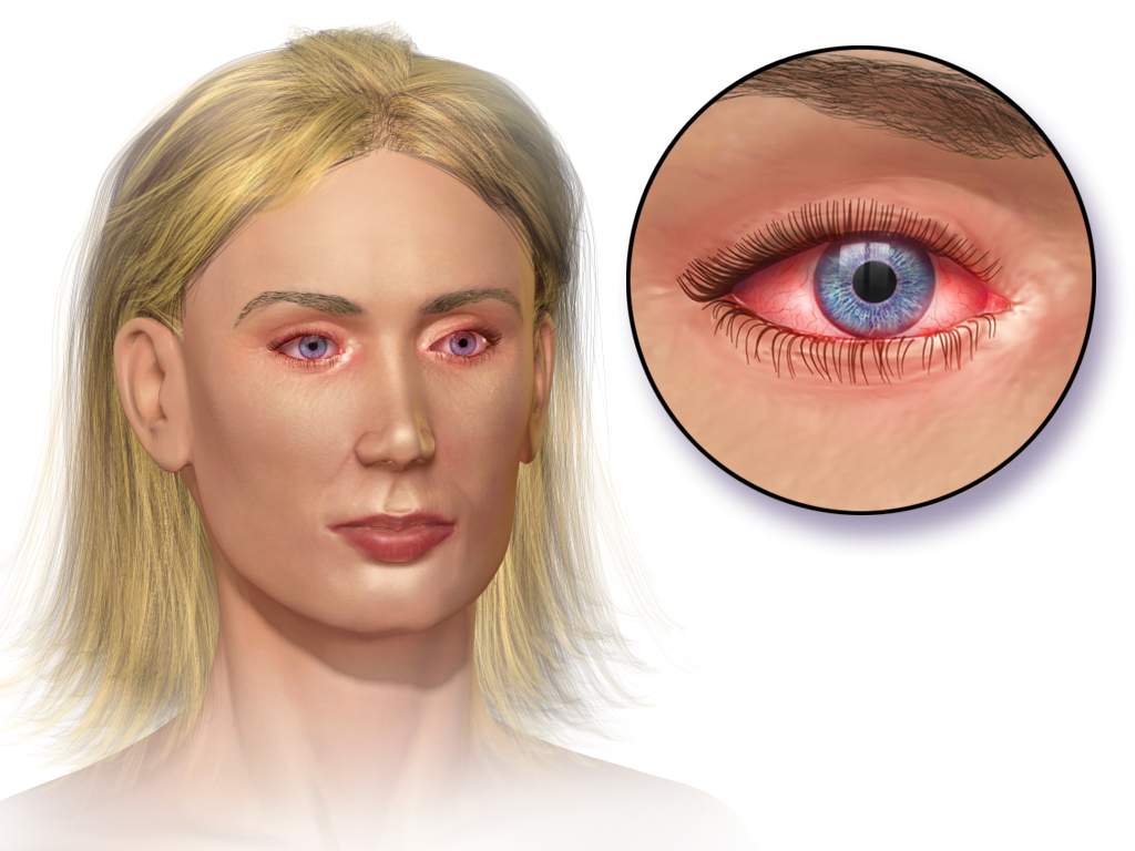 Medical illustration showing conjunctival inflammation and swelling in allergic conjunctivitis.