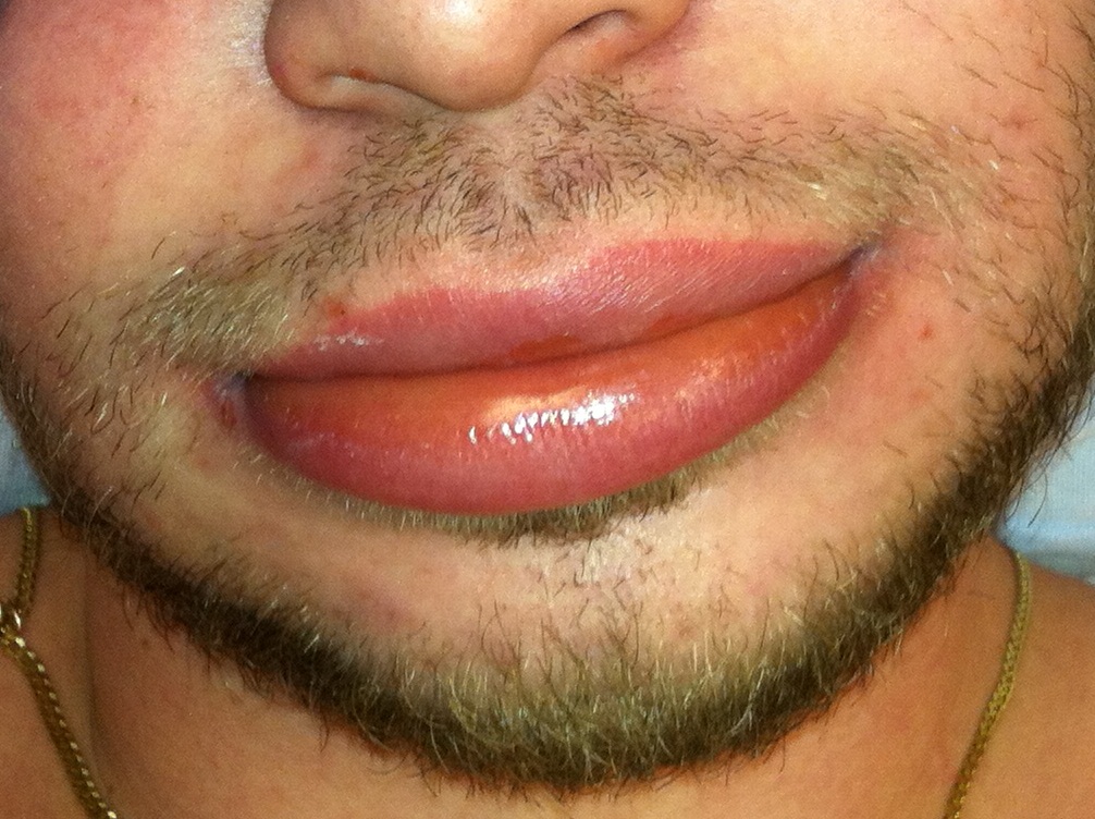 Pronounced localised swelling of the lips caused by angioedema.