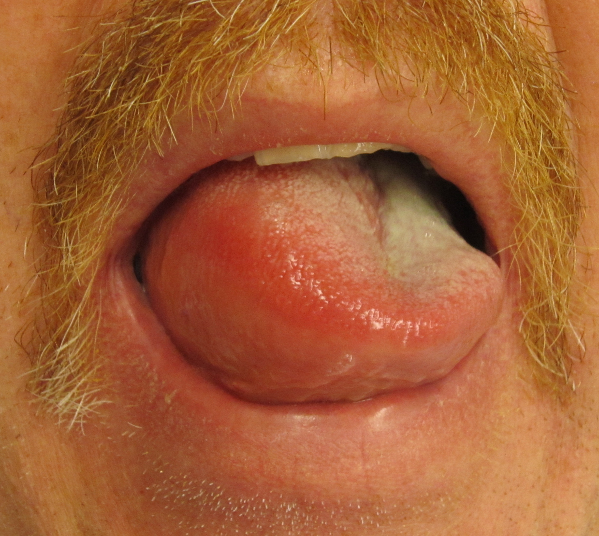 Marked swelling of the tongue caused by angioedema.