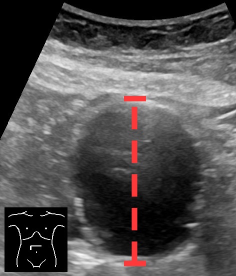 Axial ultrasound of an abdominal aortic aneurysm with a measurement line across its anteroposterior diameter.
