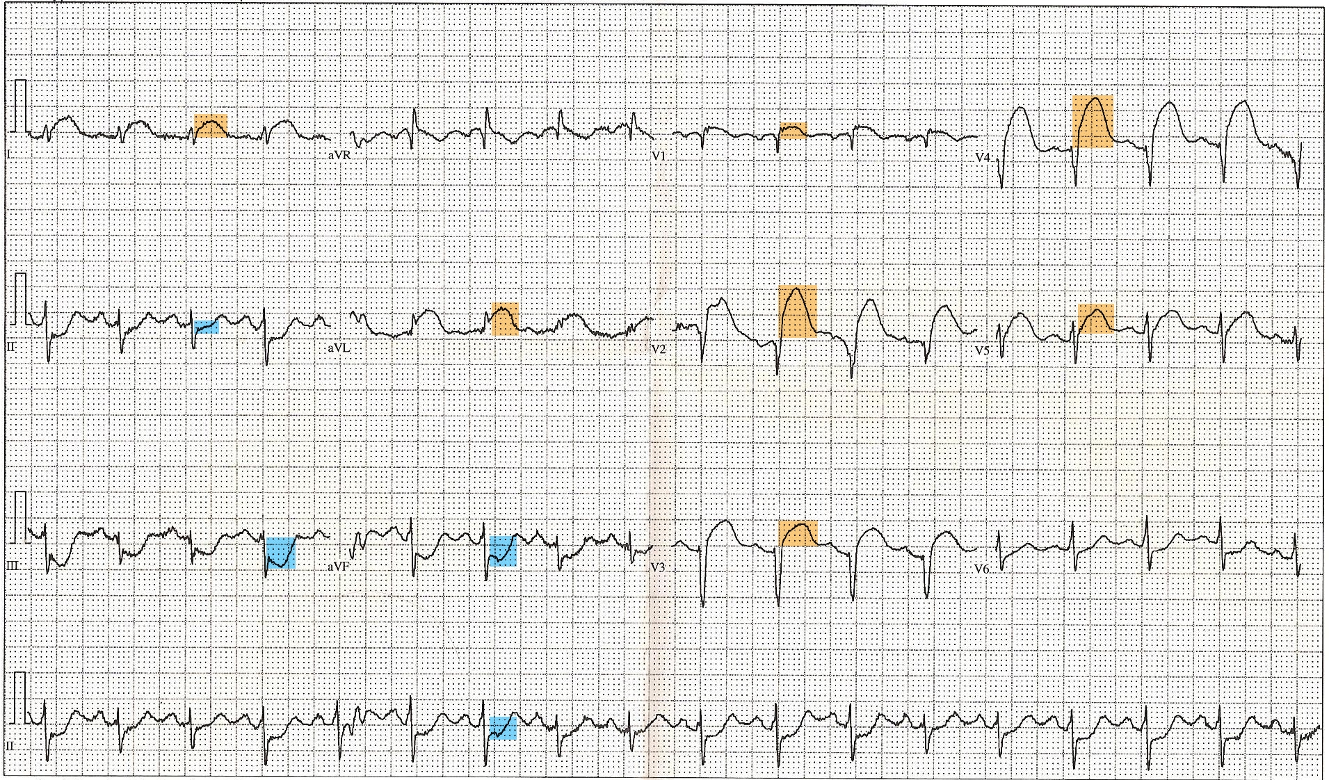 Twelve-lead ECG with orange highlighting over anterior ST elevation and blue highlighting over reciprocal inferior ST depression.
