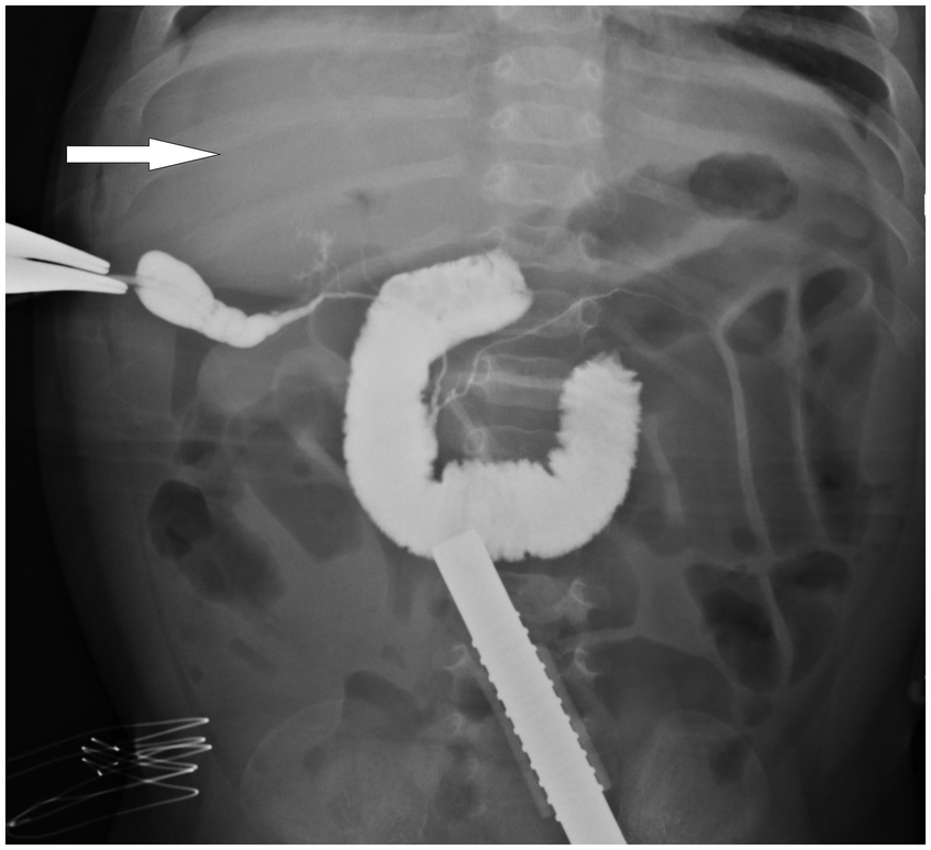 Intraoperative cholangiogram showing absent contrast filling of the intrahepatic bile ducts in biliary atresia