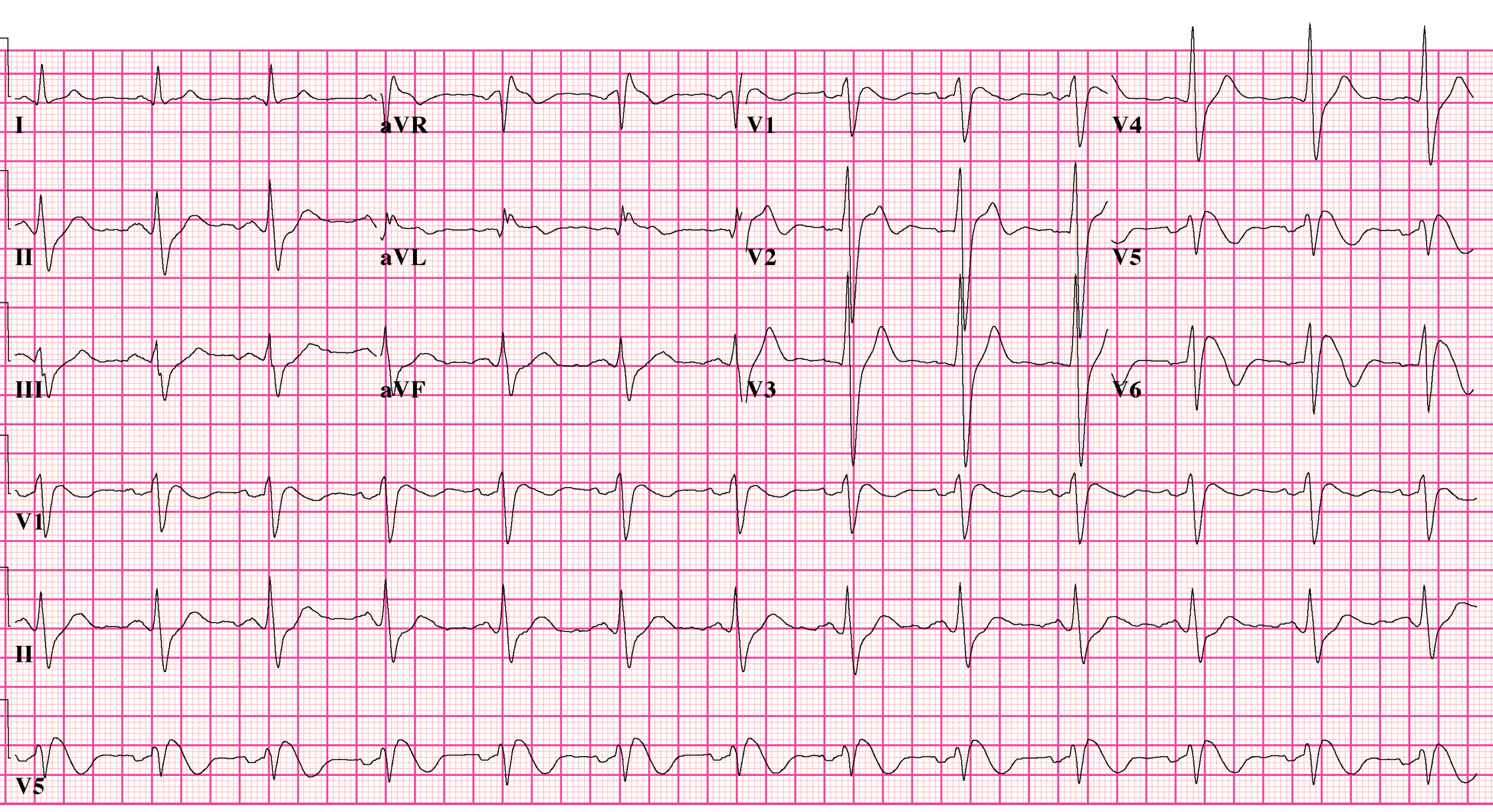 Twelve-lead ECG demonstrating a type 1 Brugada pattern with coved ST elevation and T-wave inversion in the right precordial and high-right-precordial leads.