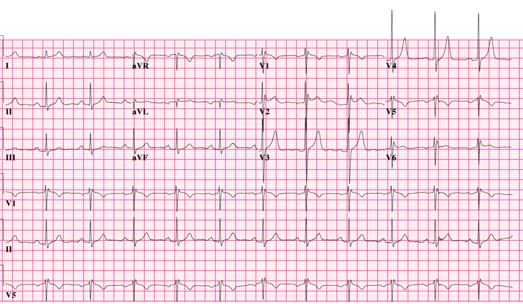 Twelve-lead ECG showing a type 2 Brugada saddleback pattern with RSR morphology, ST elevation and a positive T wave in the right precordial leads.