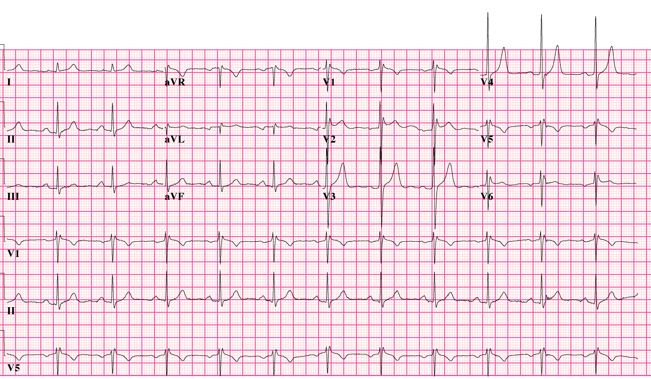 Twelve-lead ECG showing a type 2 Brugada saddleback pattern with RSR morphology, ST elevation and a positive T wave in the right precordial leads.