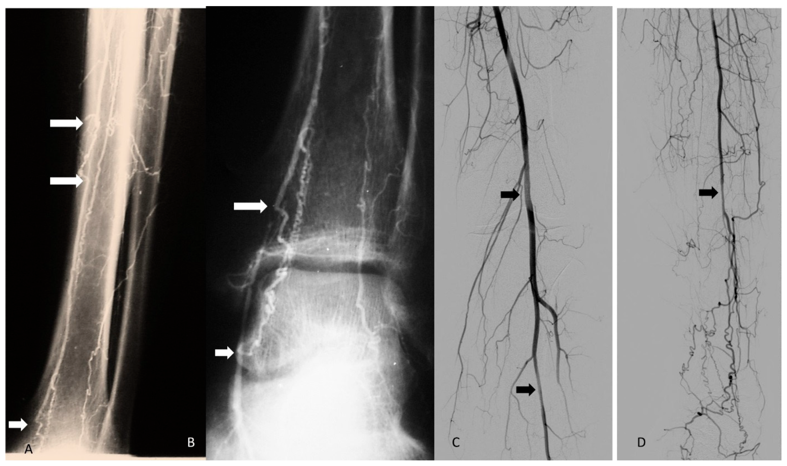 Angiographic panels demonstrating segmental infrapopliteal arterial stenoses and occlusions bypassed by tortuous corkscrew collateral vessels.