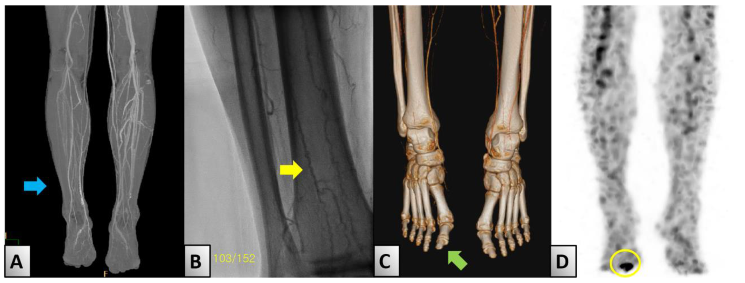 Multimodal imaging showing lower-limb arterial stenosis, corkscrew collateral vessels and osteomyelitis complicating an ischaemic great-toe ulcer.