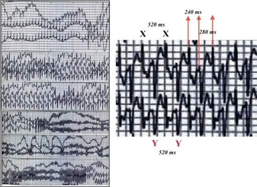 ECG from a patient with catecholaminergic polymorphic ventricular tachycardia showing bidirectional ventricular tachycardia with alternating QRS morphology.