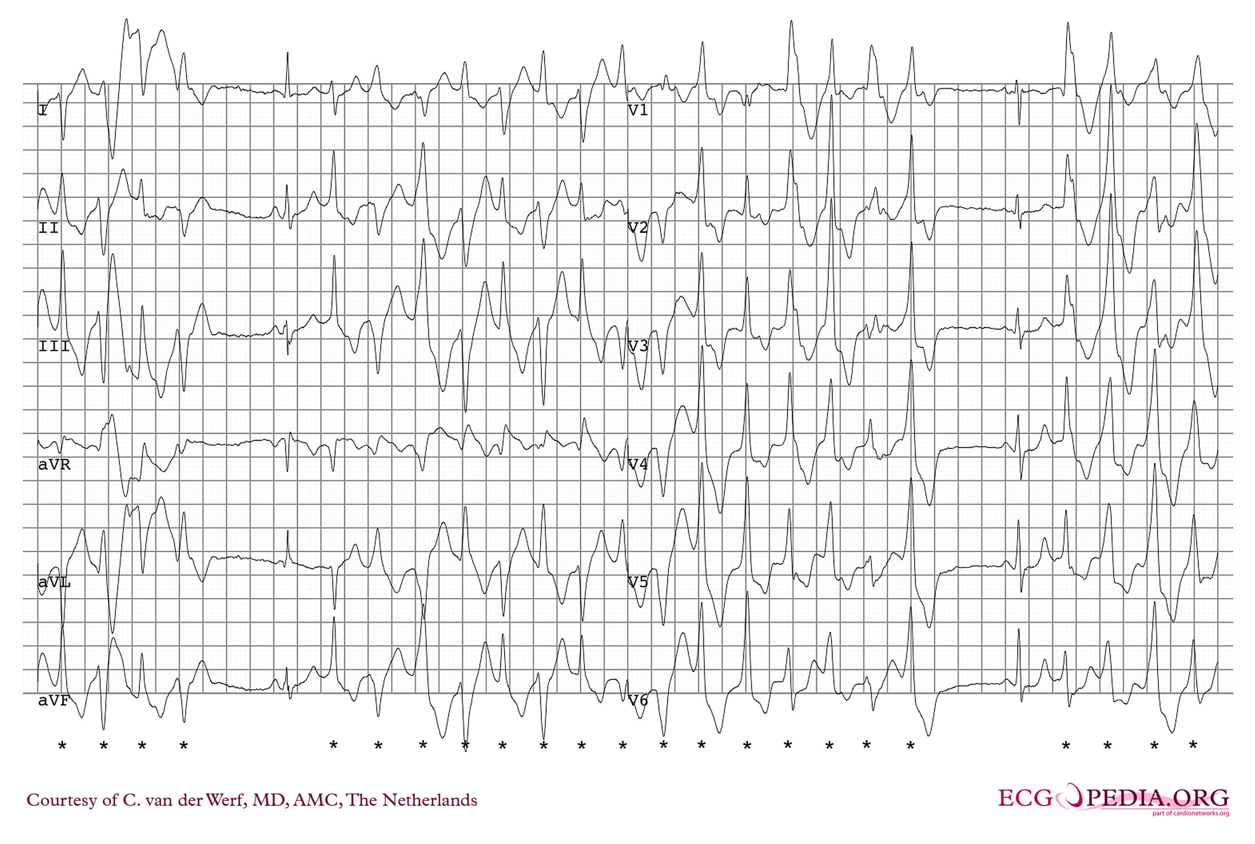 Exercise ECG from the same patient with catecholaminergic polymorphic ventricular tachycardia showing polymorphic ventricular ectopy.