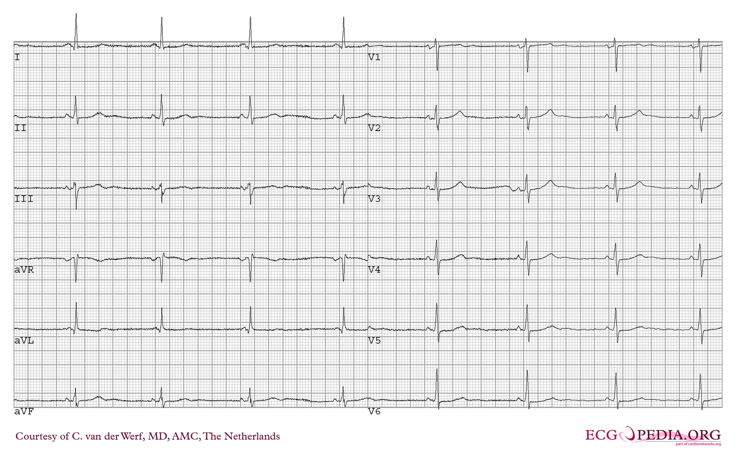 Resting 12-lead ECG from a patient with catecholaminergic polymorphic ventricular tachycardia.
