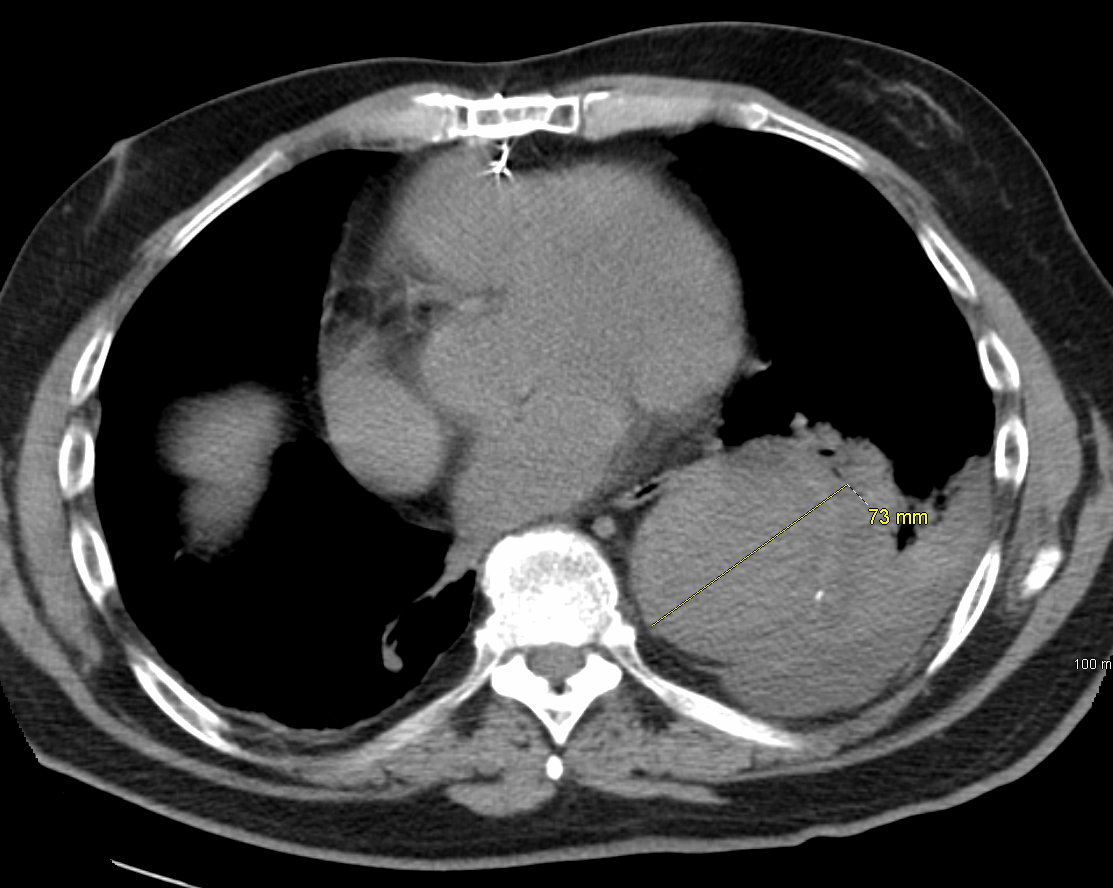 Axial CT of the thorax showing marked aneurysmal dilatation of the thoracic aorta.
