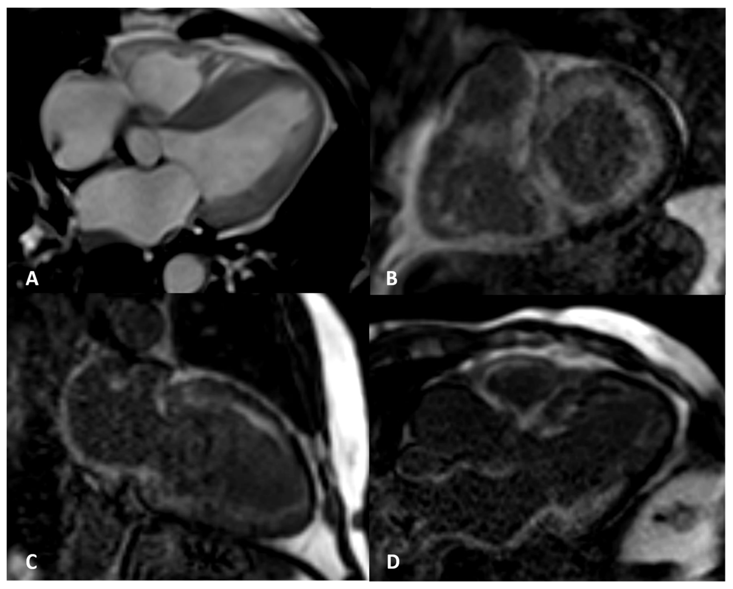 Cardiac MRI panels showing diffusely elevated native T1 and extensive left and right ventricular late gadolinium enhancement in cardiac amyloidosis.