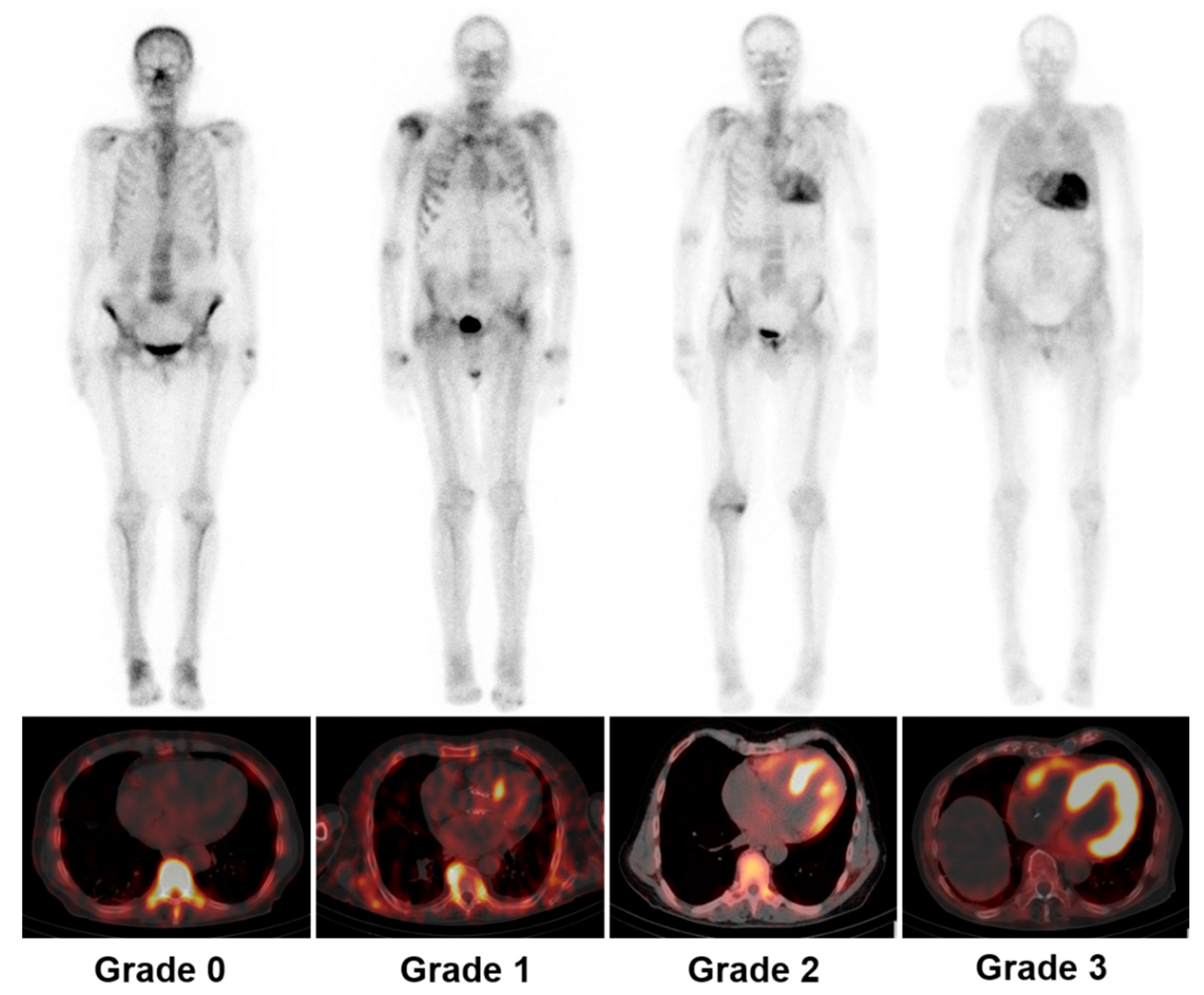 Bone-scintigraphy images demonstrating increasing myocardial tracer uptake from Perugini Grade 0 through Grade 3.