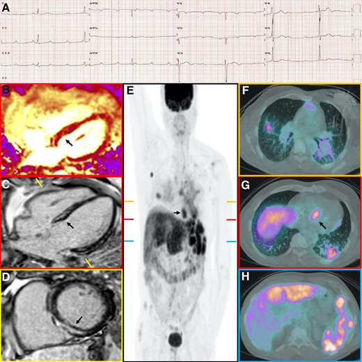 ECG showing complete heart block with cardiac MRI and PET-CT findings in cardiac sarcoidosis
