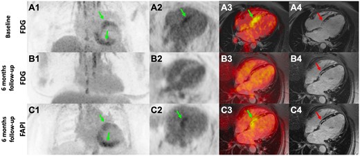 Hybrid FDG-PET and cardiac MRI showing active myocardial inflammation and late gadolinium enhancement in cardiac sarcoidosis