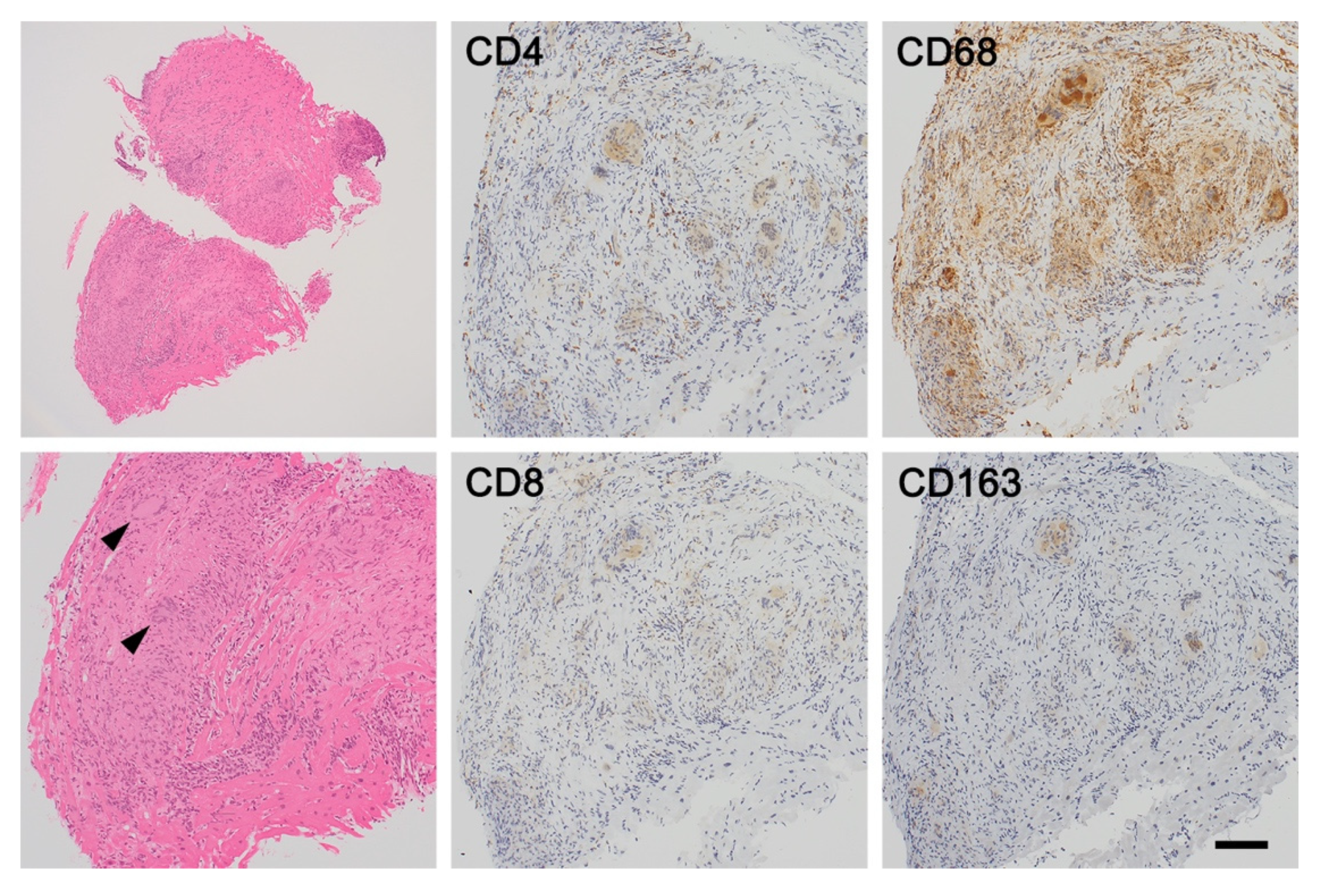 Histology of cardiac sarcoidosis showing well-formed non-necrotising myocardial granulomas