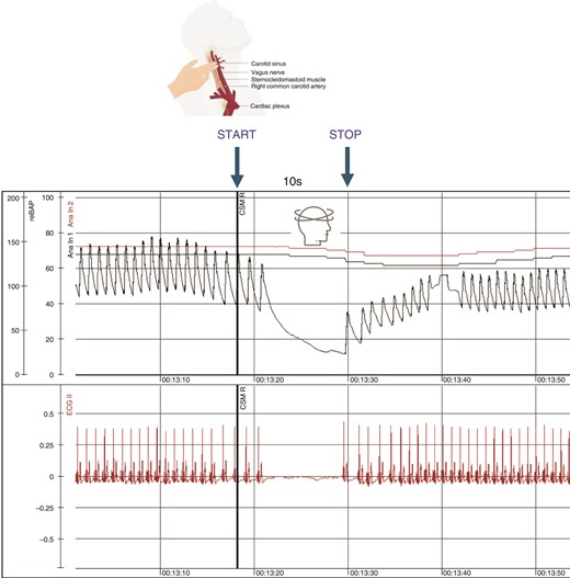 Continuous ECG and blood pressure tracing showing carotid sinus massage causing prolonged sinus arrest and syncope