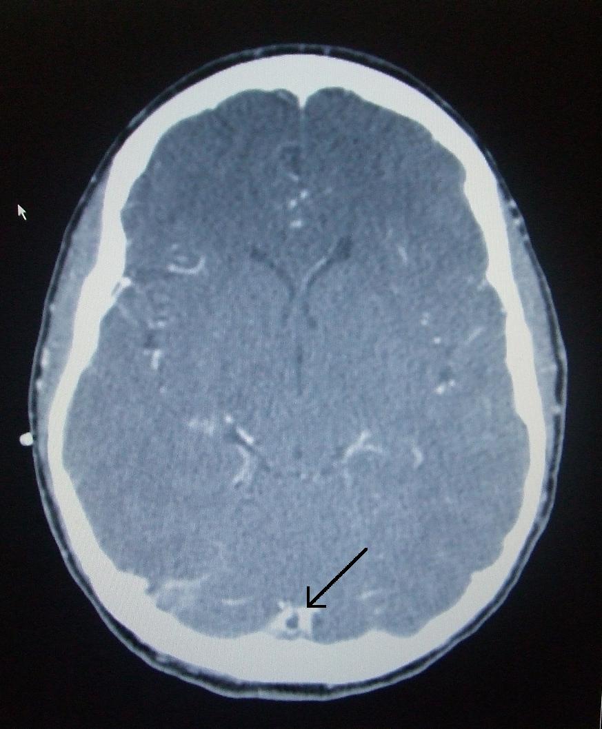 CT venogram showing a filling defect consistent with superior sagittal sinus thrombosis.