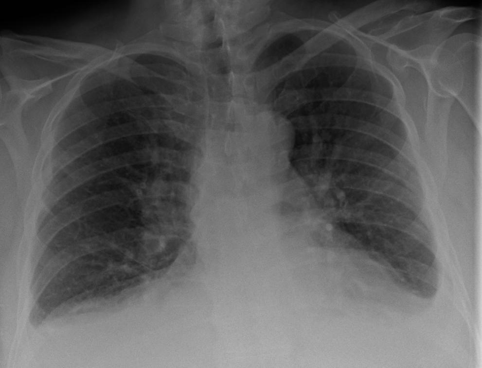 Chest X-ray showing cardiomegaly, pulmonary vascular congestion, Kerley B lines and small pleural effusions.