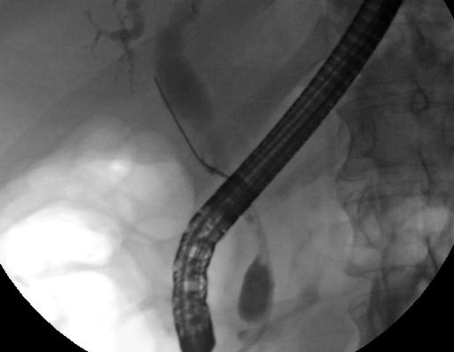 ERCP image showing narrowing of the common bile duct and dilatation of the proximal bile duct.