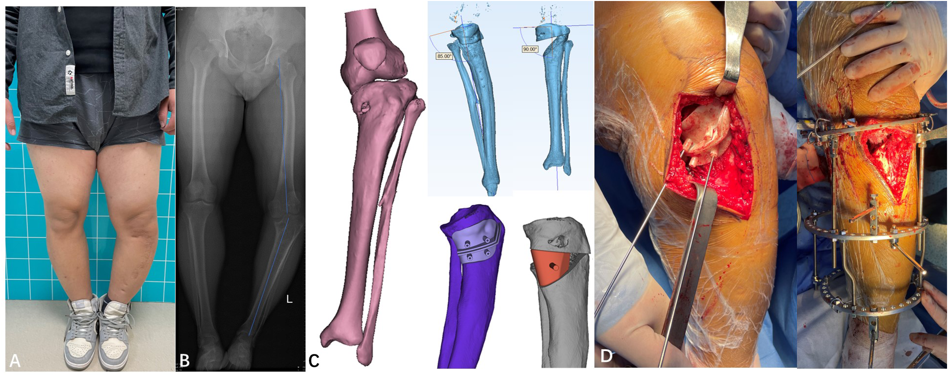 Clinical photograph and imaging demonstrating unilateral varus deformity in advanced Blount’s disease.