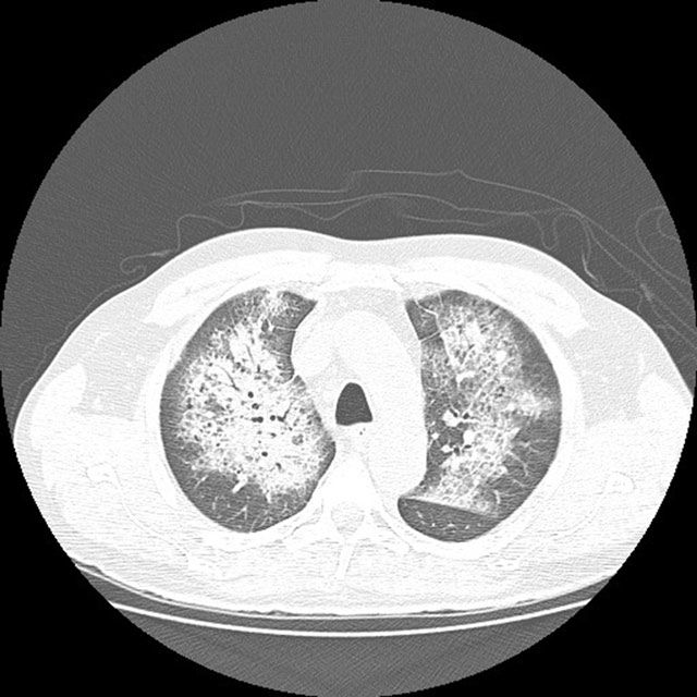 Axial high-resolution chest CT showing bilateral perihilar ground-glass opacity and interlobular septal thickening in diffuse alveolar haemorrhage.