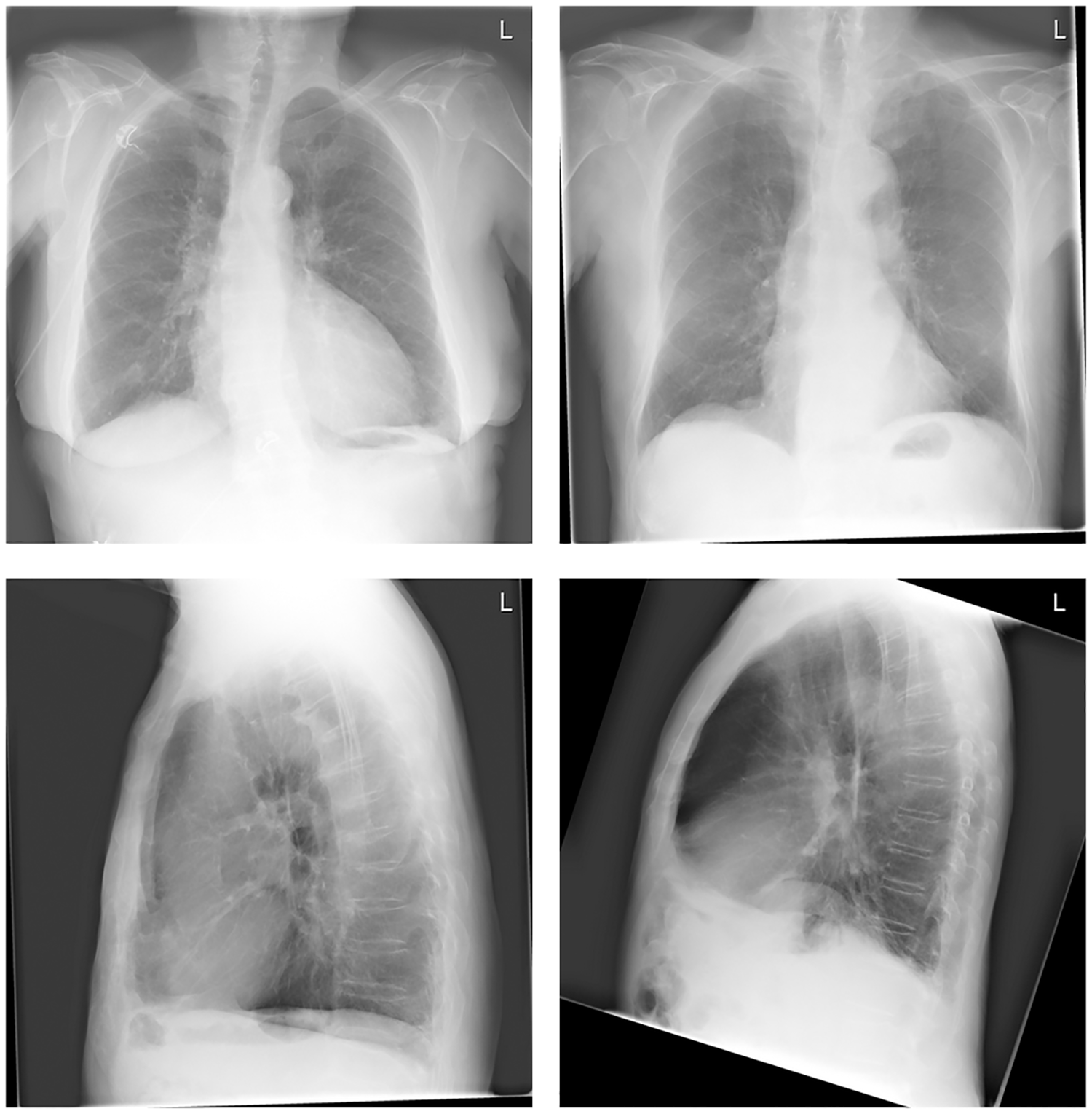 Four chest radiographs demonstrating emphysema, including flattened diaphragms, increased lung lucency and enlarged retrosternal airspace.