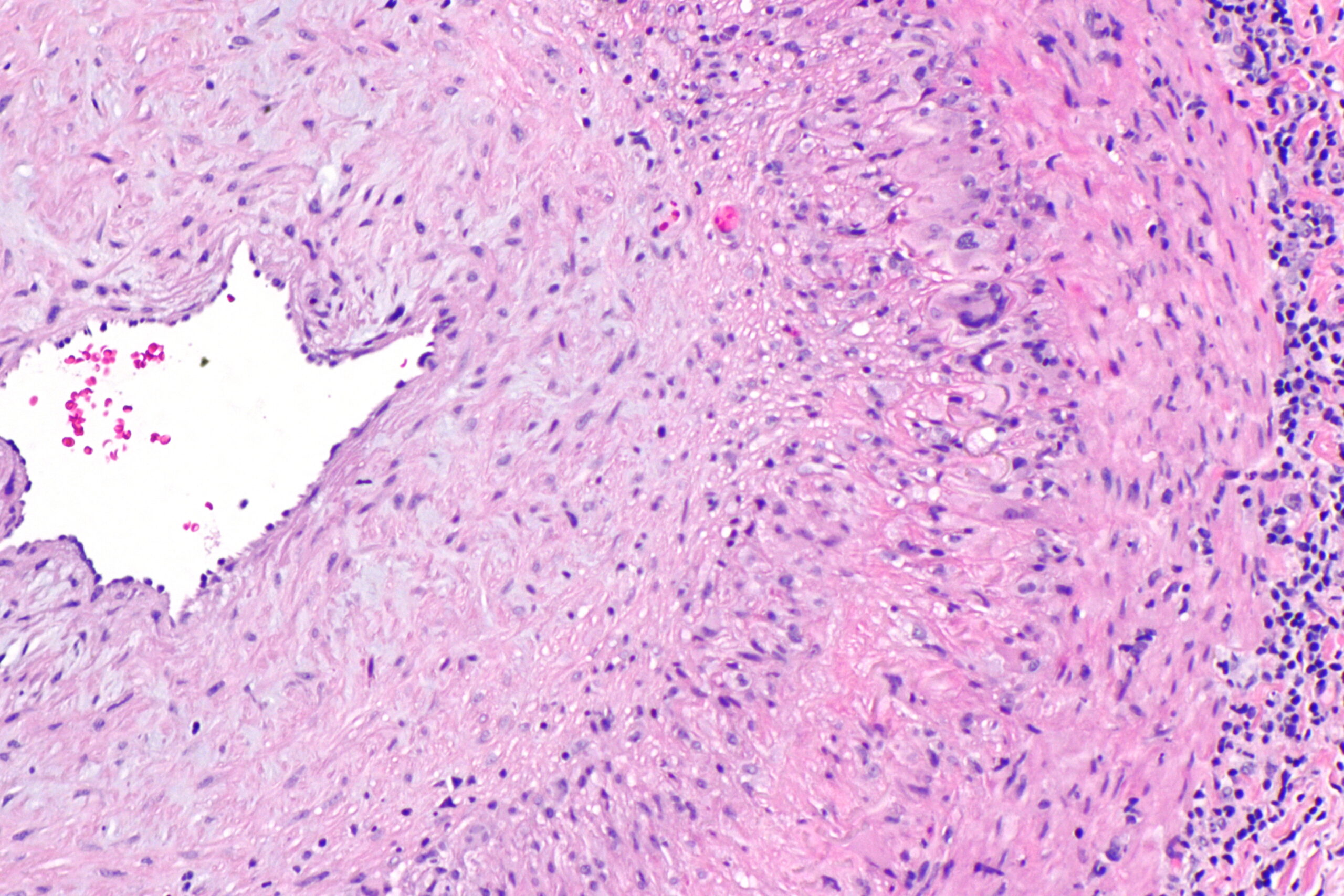 Histological section of an artery showing granulomatous inflammation and multinucleated giant cells.