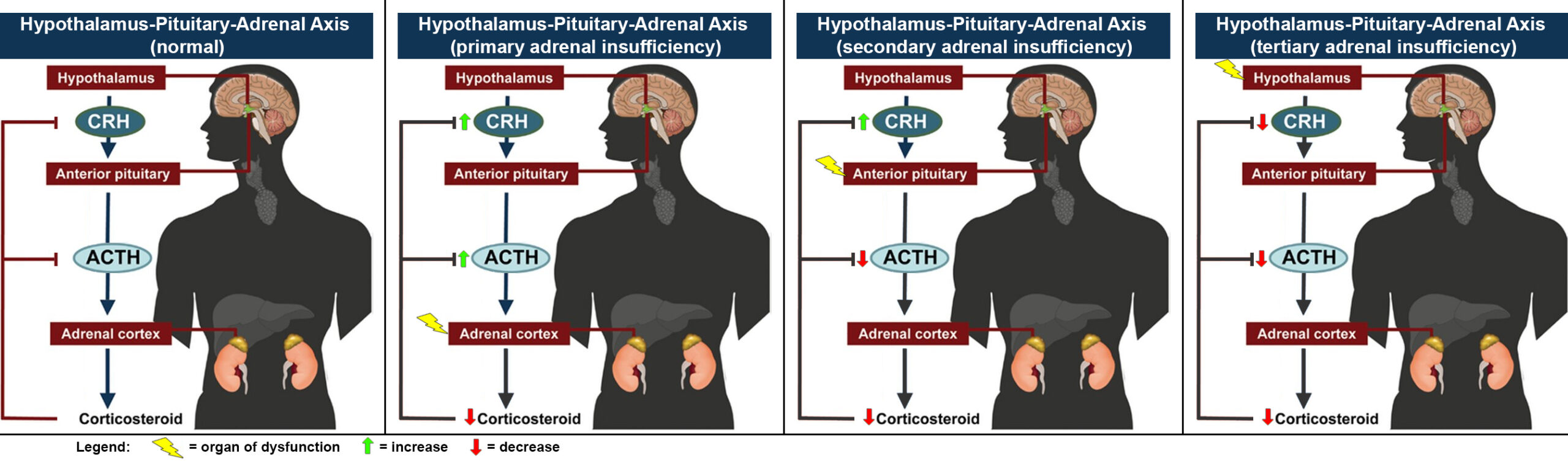 Diagram comparing the hypothalamic-pituitary-adrenal axis in normal physiology and primary, secondary and tertiary adrenal insufficiency