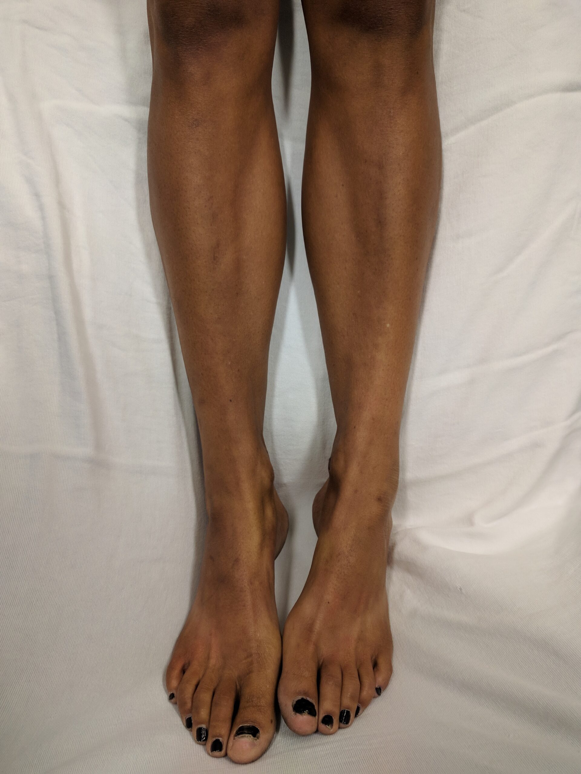 Clinical photograph showing hyperpigmentation of the legs in primary adrenal insufficiency
