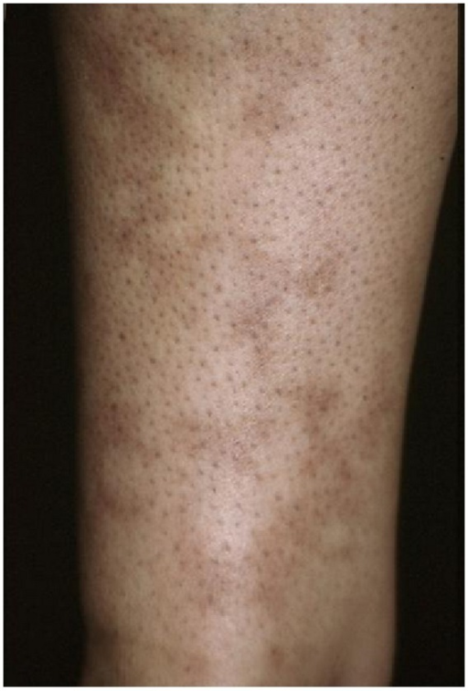 Violaceous, net-like livedo reticularis pattern over the skin of an arm.