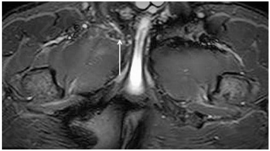 Axial oblique MRI of the pelvis showing right adductor longus tendinopathy at the proximal attachment
