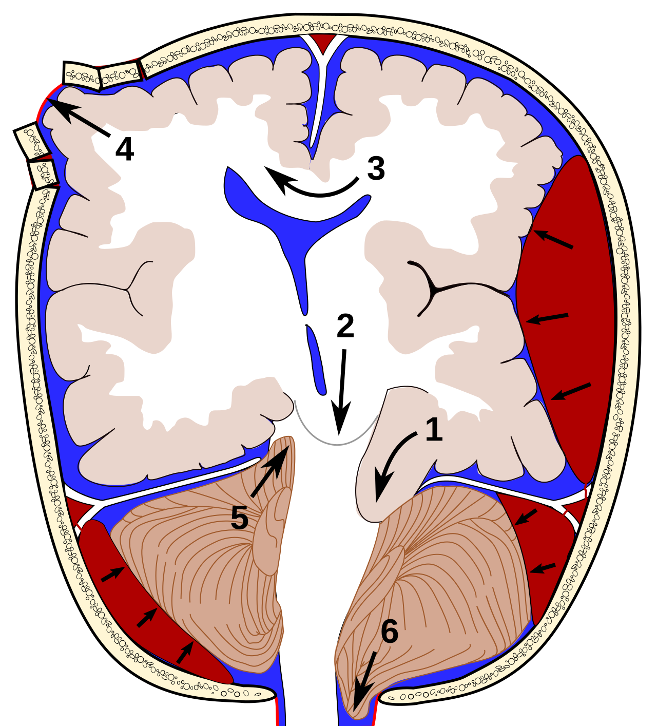Six-panel anatomical diagram showing uncal, central, subfalcine, transcalvarial, upward cerebellar and tonsillar brain herniation.