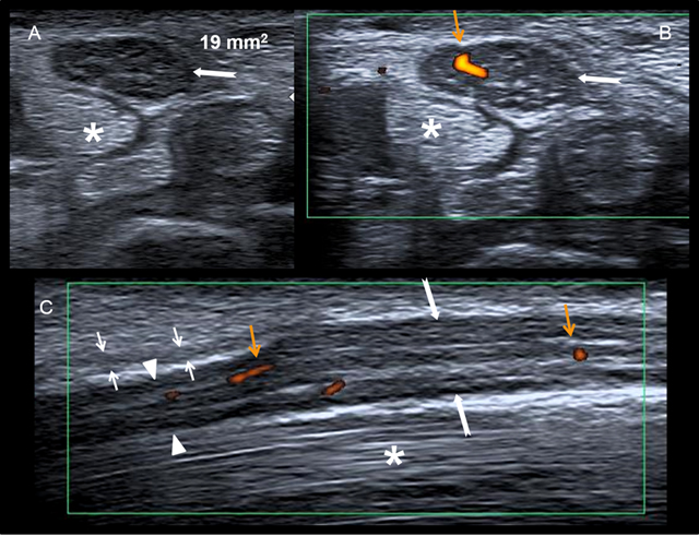 Axial and longitudinal ultrasound images showing an enlarged median nerve proximal to the flexor retinaculum with distal flattening and increased Doppler flow.