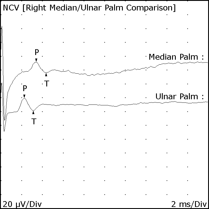 Comparative median and ulnar sensory nerve-conduction waveforms showing delayed median peak latency across the wrist.