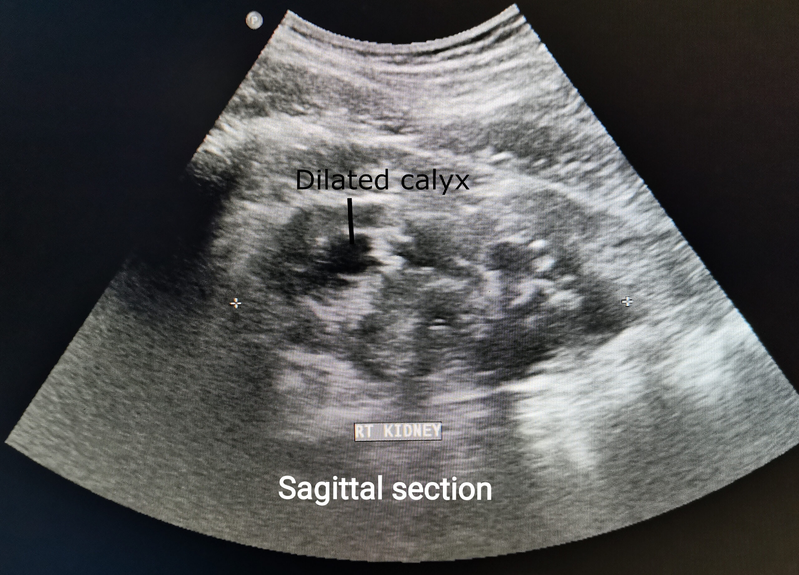 Renal ultrasound showing multiple dilated calyces consistent with moderate hydronephrosis.