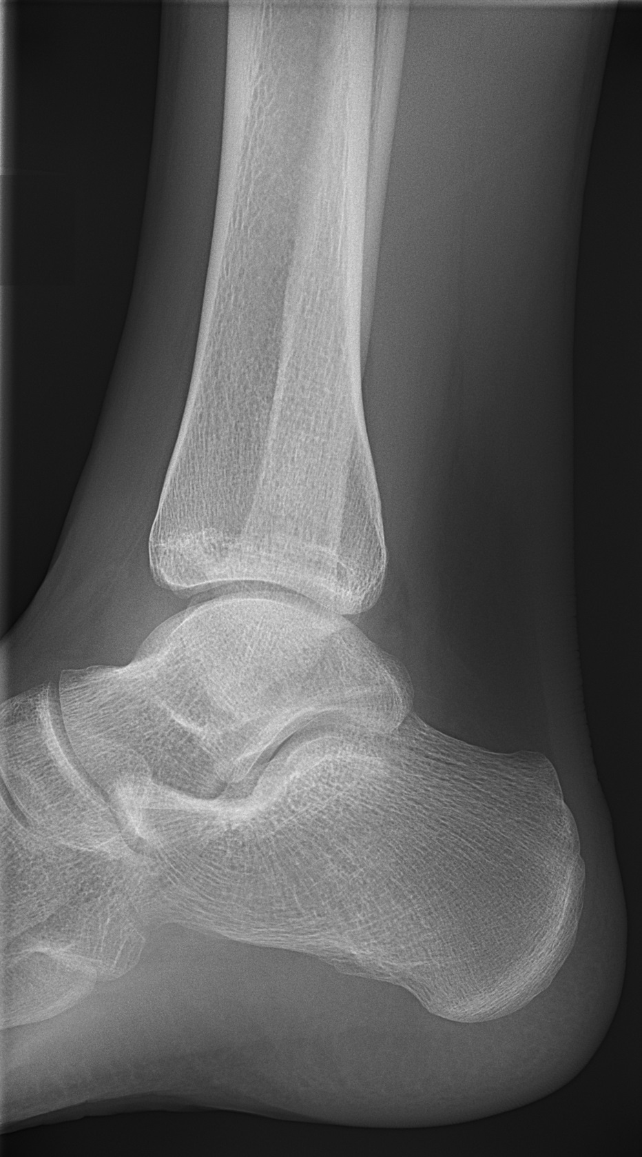 Lateral radiograph of an adult ankle showing no fracture after persistent pain following an ankle sprain.