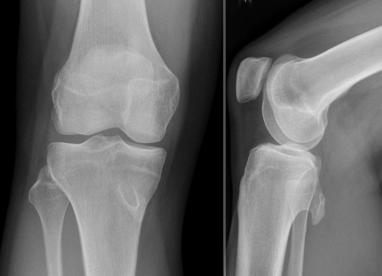 Radiograph showing a bony exostosis arising from the proximal tibia.