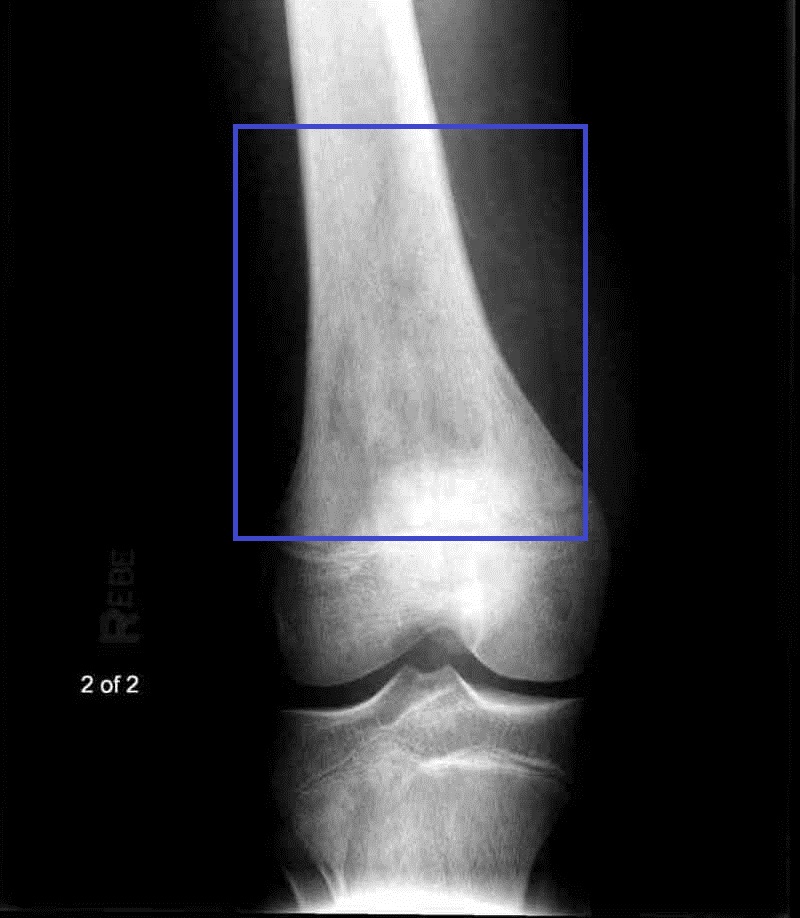 Radiograph showing an aggressive osteosarcoma involving the distal femur.