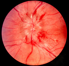 Fundus photograph showing optic-disc swelling and blurred disc margins consistent with papilloedema.